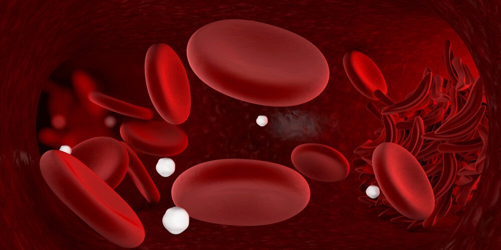 Genética y anemia de células falciformes