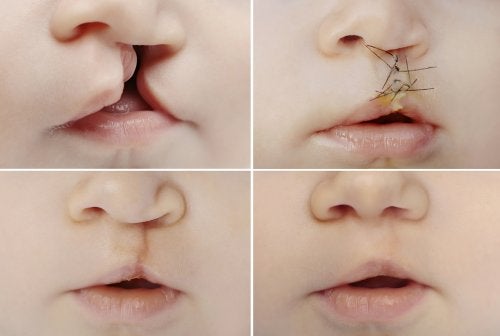 Labio leporino: causas y tratamiento