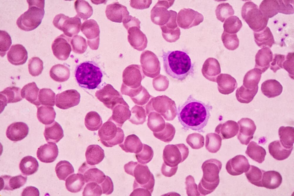 Linfoma o leucemia