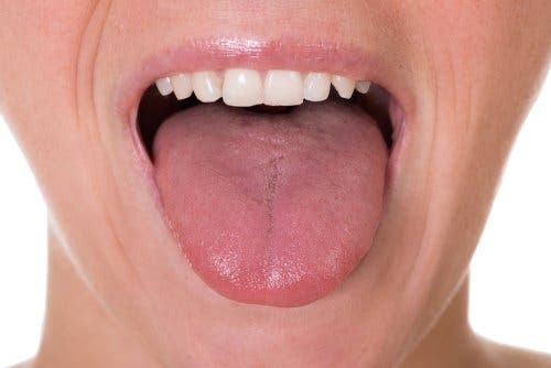 Cáncer de lengua