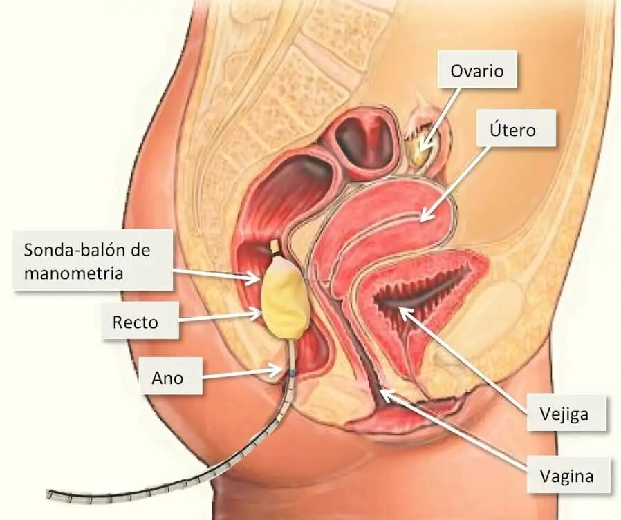 Manometría anorrectal