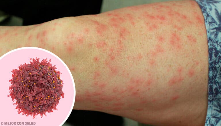 Micosis fungoide: qué es y en qué consiste