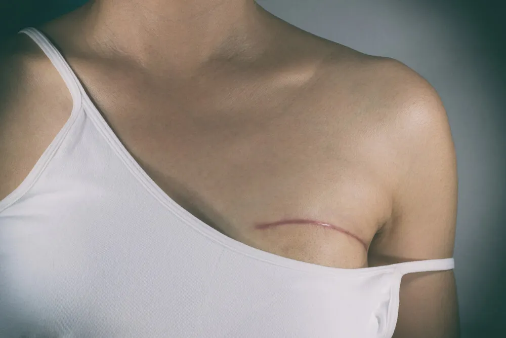 Mastectomía con riesgo de seroma.