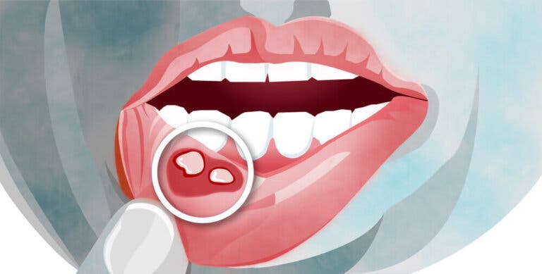 ¿Se pueden aliviar las aftas en la boca con remedios naturales?