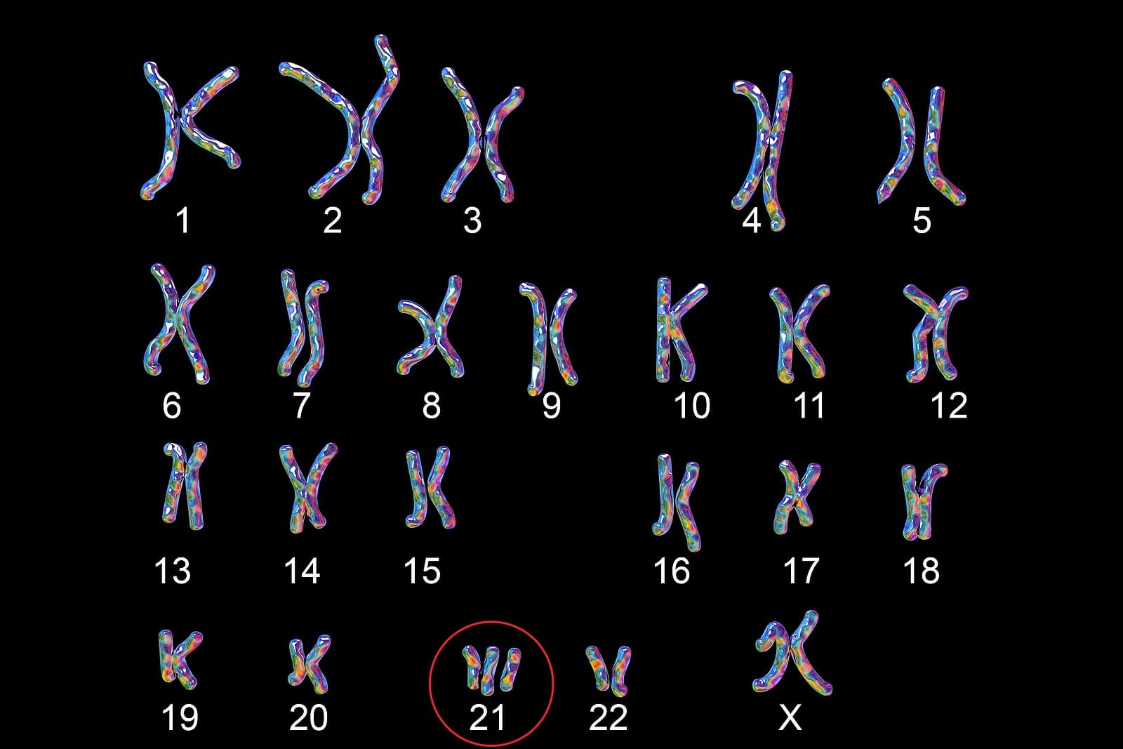 Das Edwards-Syndrom - Chromosomen