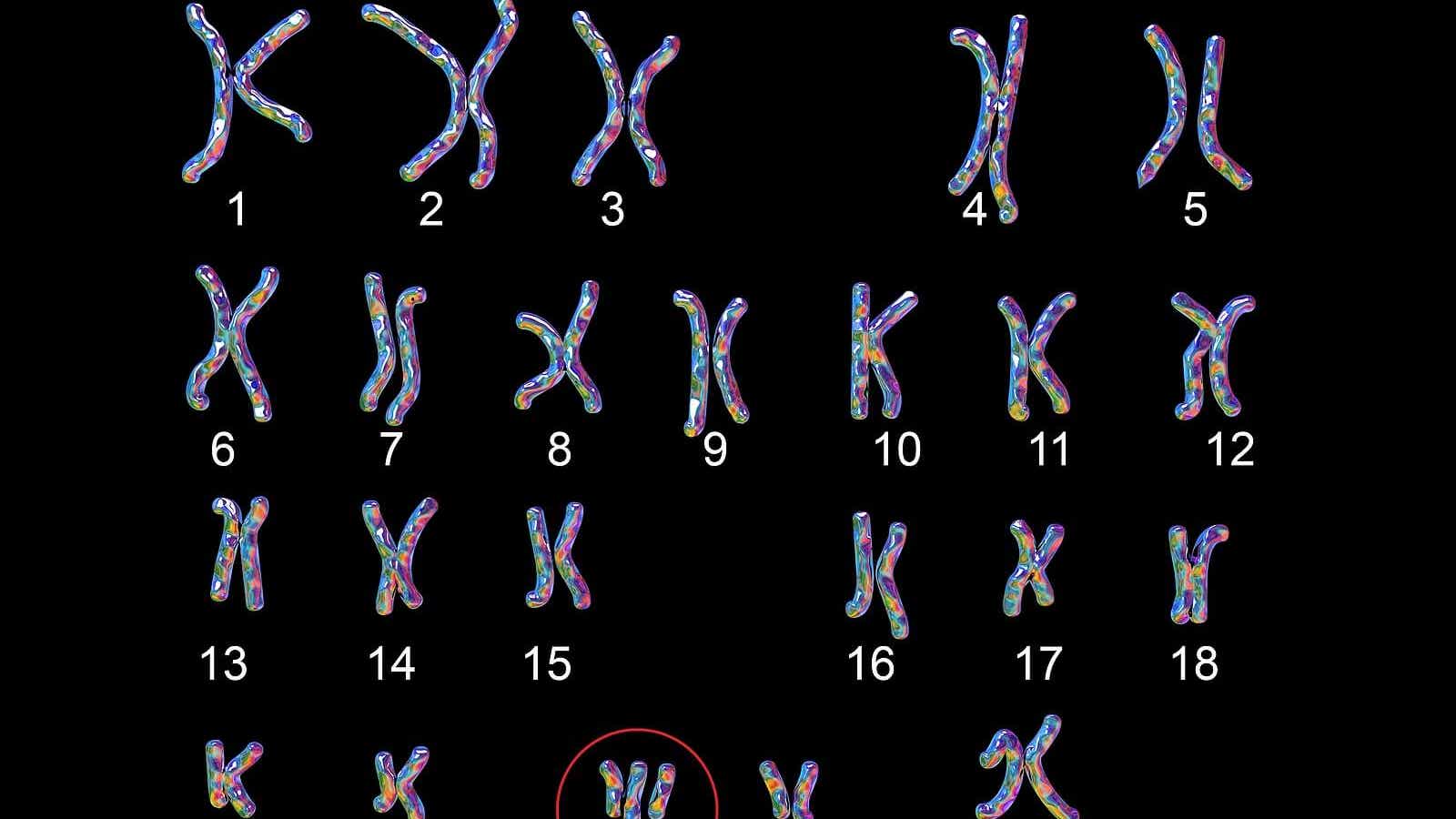 Edwards Syndrome Symptoms And Causes Of Trisomy 18 edwards-syndrome-symptoms-and-causes-of-trisomy-18