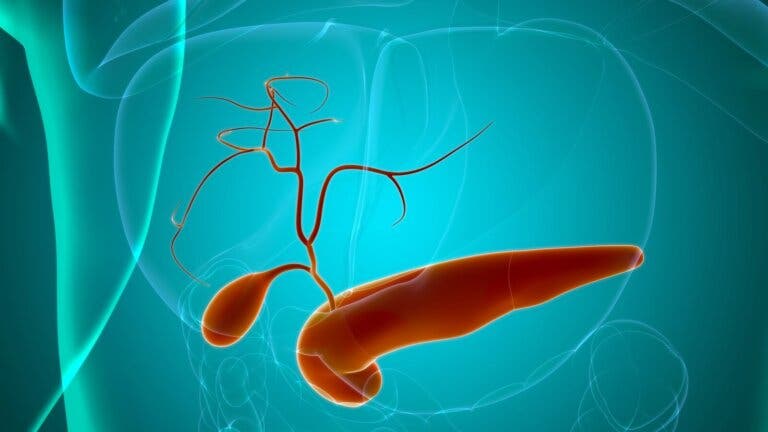 ¿Qué es la colelitiasis o cálculos en la vesícula?