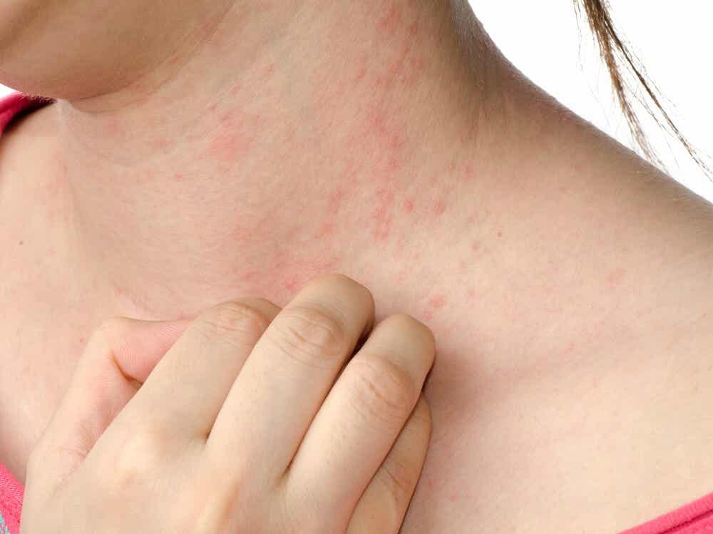El eczema y estrés están relacionados.