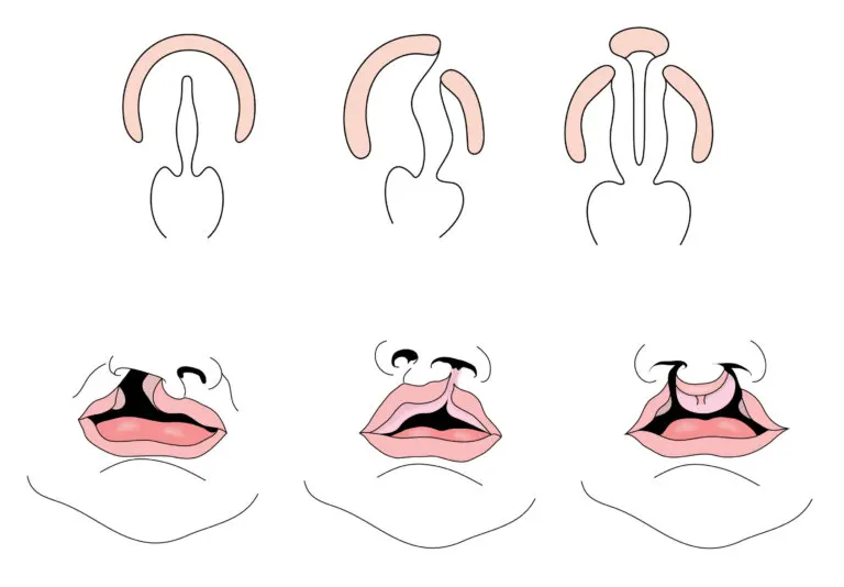 Labio leporino: causas y tratamiento