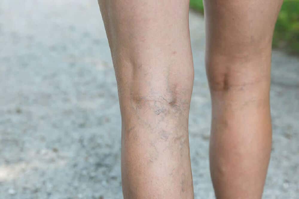 Varices en las piernas, un signo de mala circulación samguínea.
