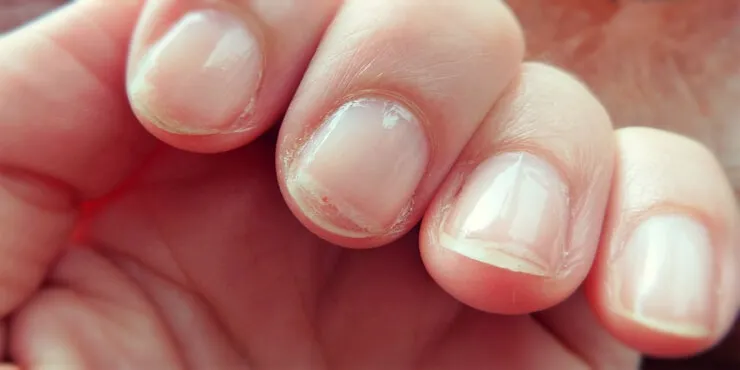 Uñas frágiles