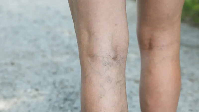 varices (2)