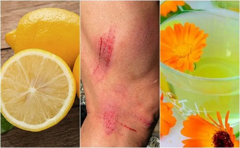 7 remedios naturales para curar rasguños en la piel