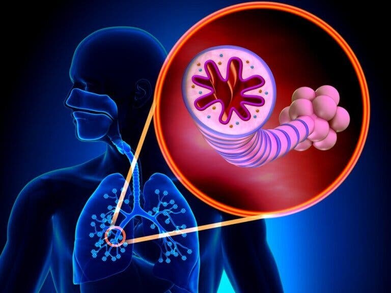 Bronquiectasia: todo lo que debes saber