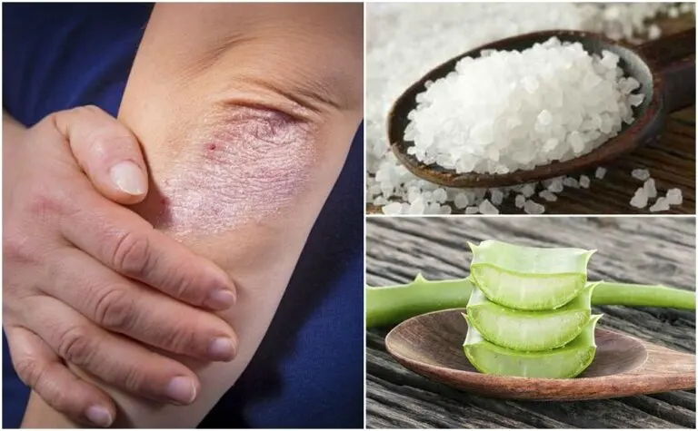 5 soluciones naturales para los hongos en la piel