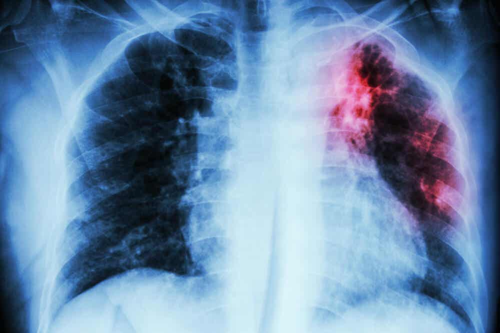 Radiografía de una persona con enfermedad pulmonar intersticial