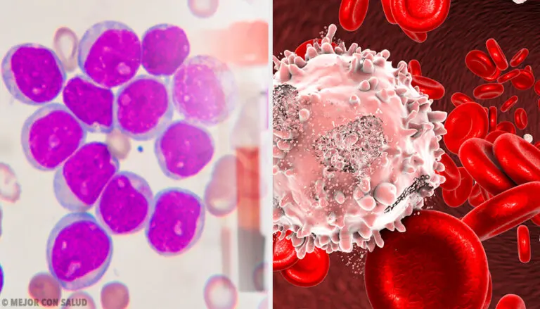 Leucemia mieloide crónica