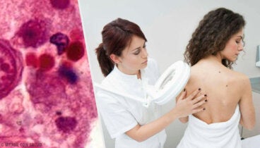 Neurofibromatosis: todo lo que debes saber