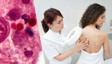 Neurofibromatosis: todo lo que debes saber