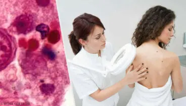 Neurofibromatosis: todo lo que debes saber