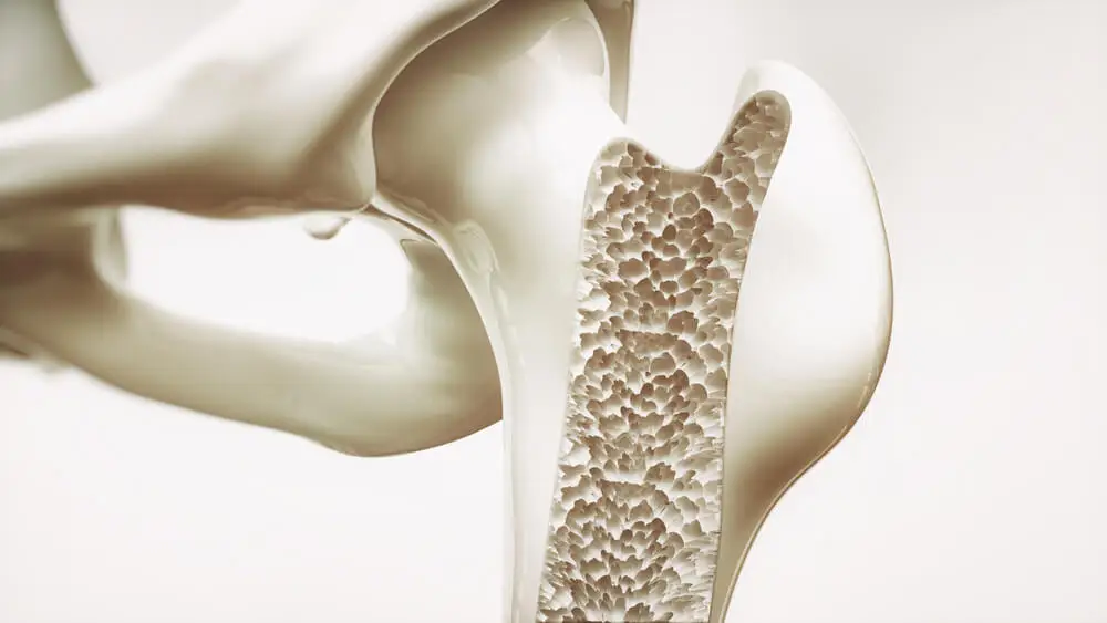 Osteopetrosis huesos demasiado densos