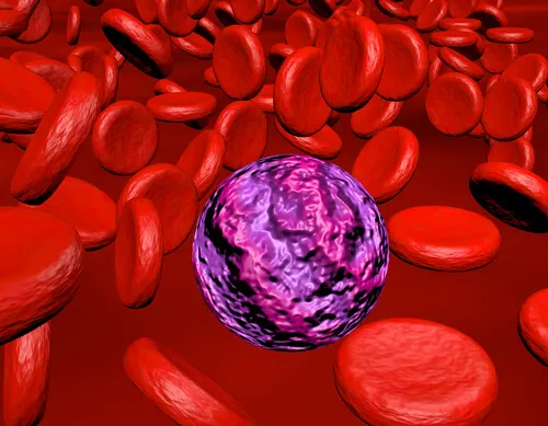leucemia mieloide crónica