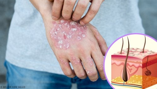 Psoriasis: causas, síntomas, diagnóstico y tratamiento