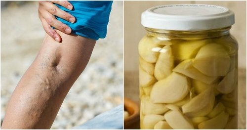 Remedio casero de ajo y naranja para tratar las varices