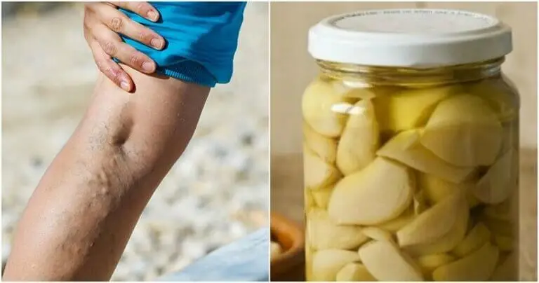 Cómo hacer pomada de ajo y limón para las varices