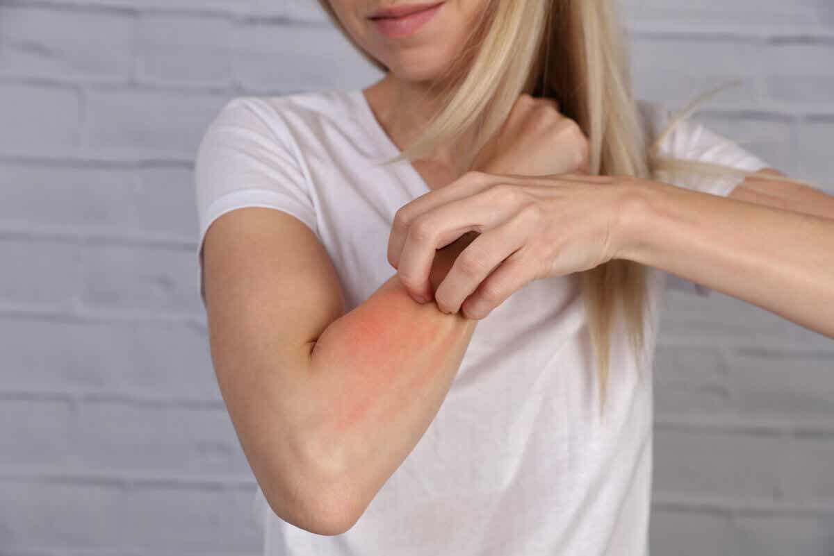 Alergia en la piel por uso de antibióticos.