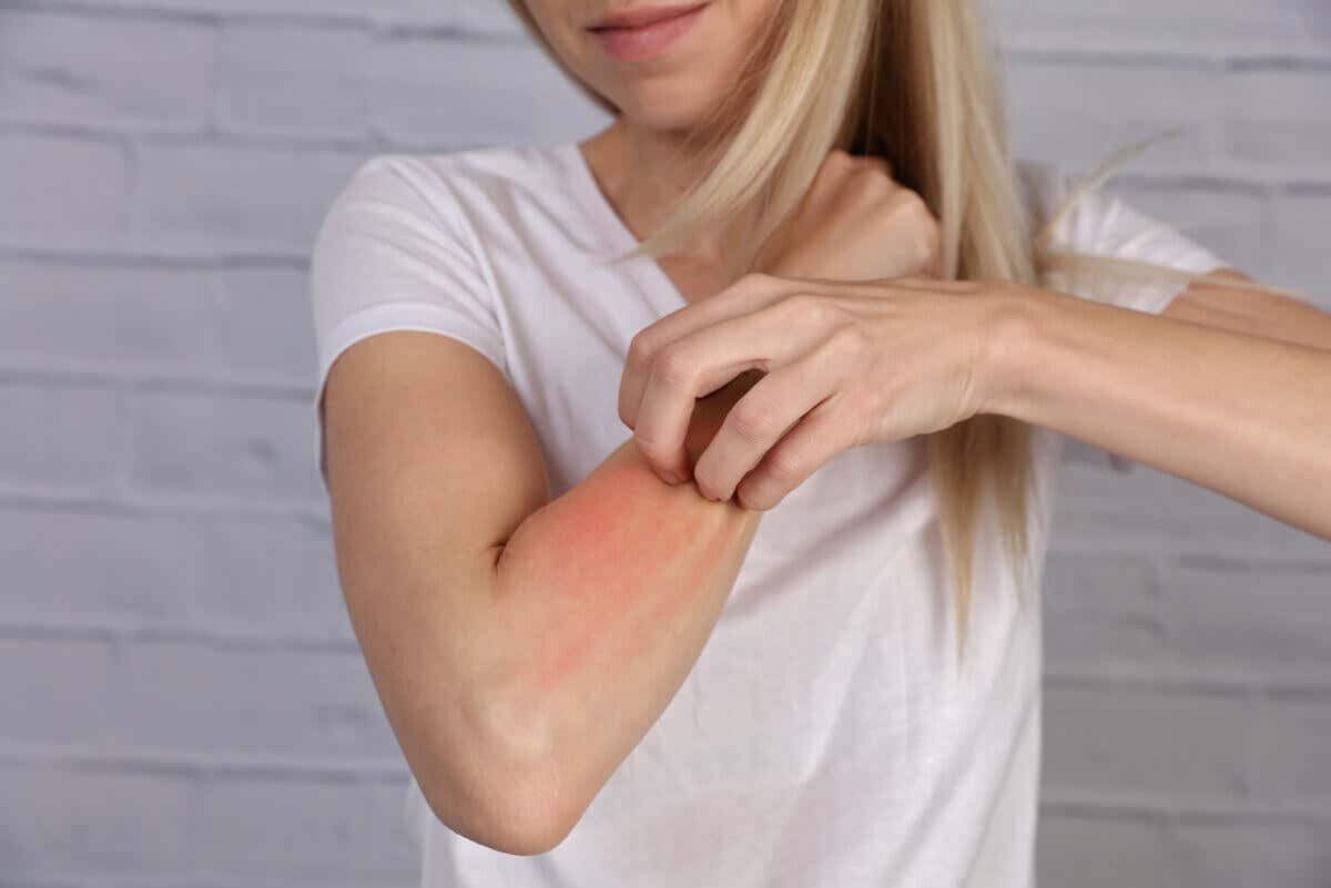 Donna con reazione allergica sul braccio.
