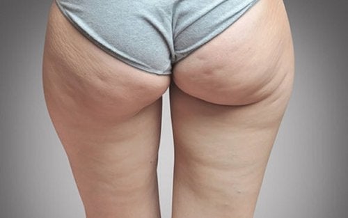 Celulitis