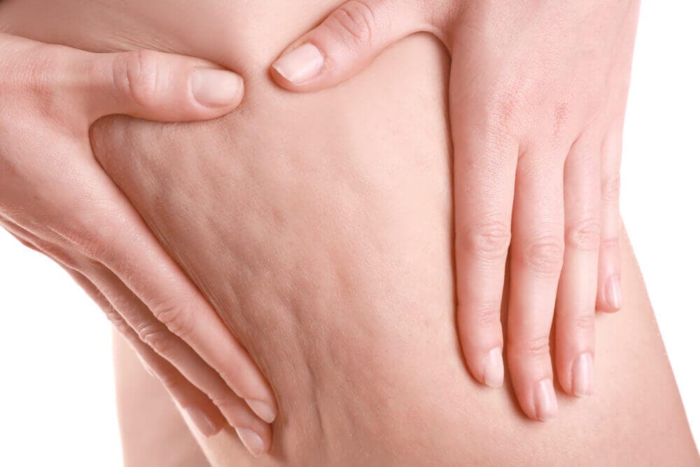 Celulitis en las piernas.