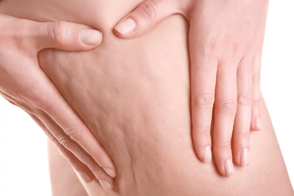 Celulitis en las piernas.