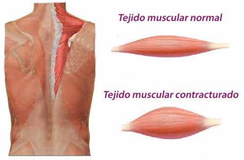 Cómo se forma una contractura muscular