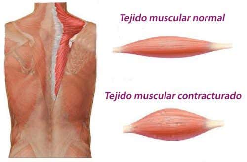 Cómo se forma una contractura muscular