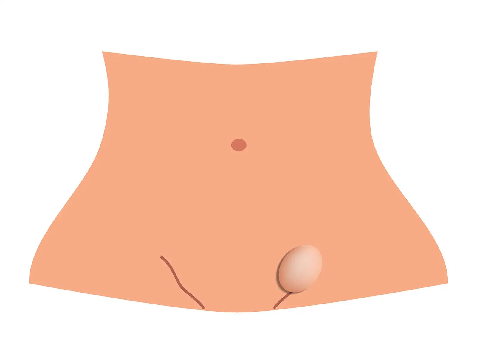 Hernia inguinal