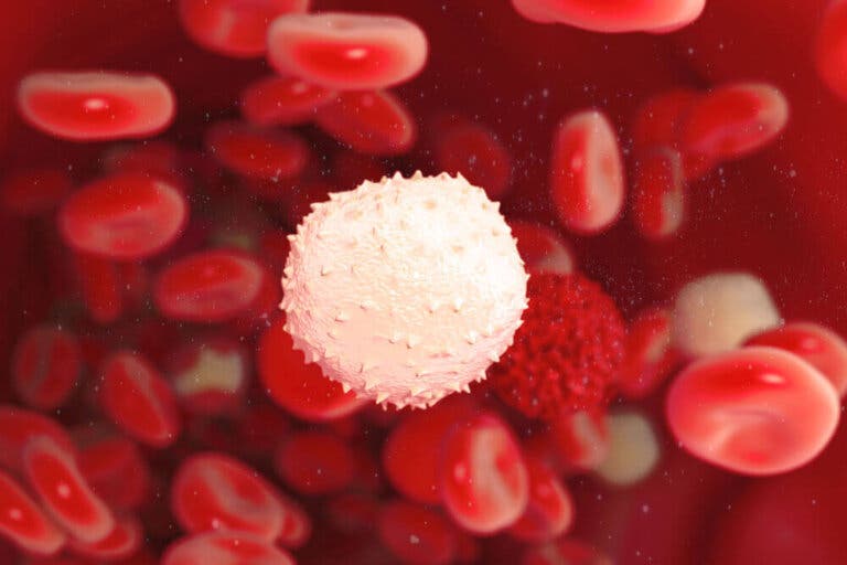 Macroglobulinemia de Waldenström: ¿qué es?