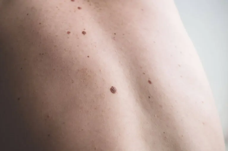 ¿Cuál es el tratamiento correcto para un lunar sospechoso?