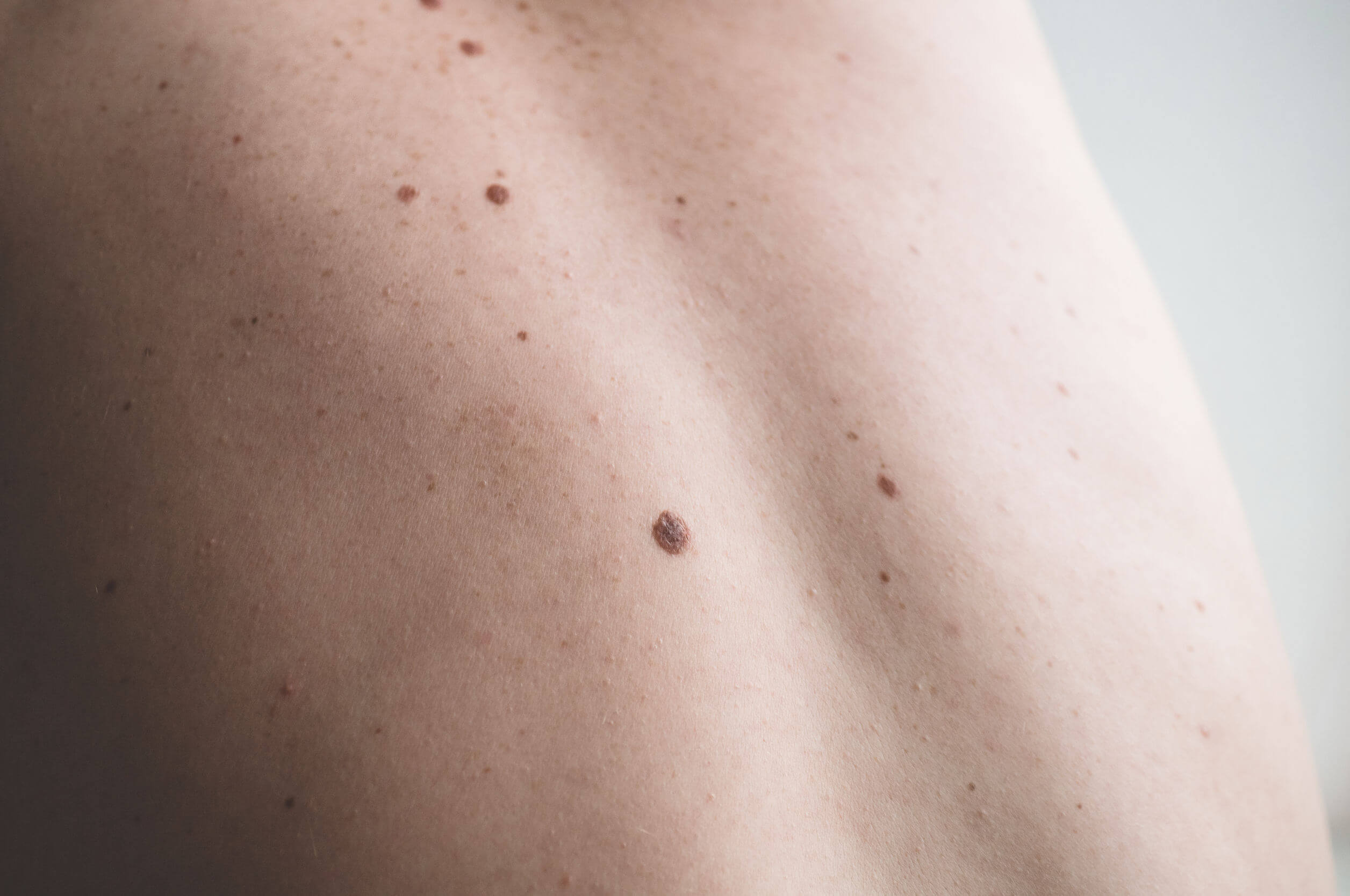 ¿Cuál es el tratamiento correcto para un lunar sospechoso? Mejor con Salud ¿Cuál es el tratamiento correcto para un lunar sospechoso? Mejor con Salud
