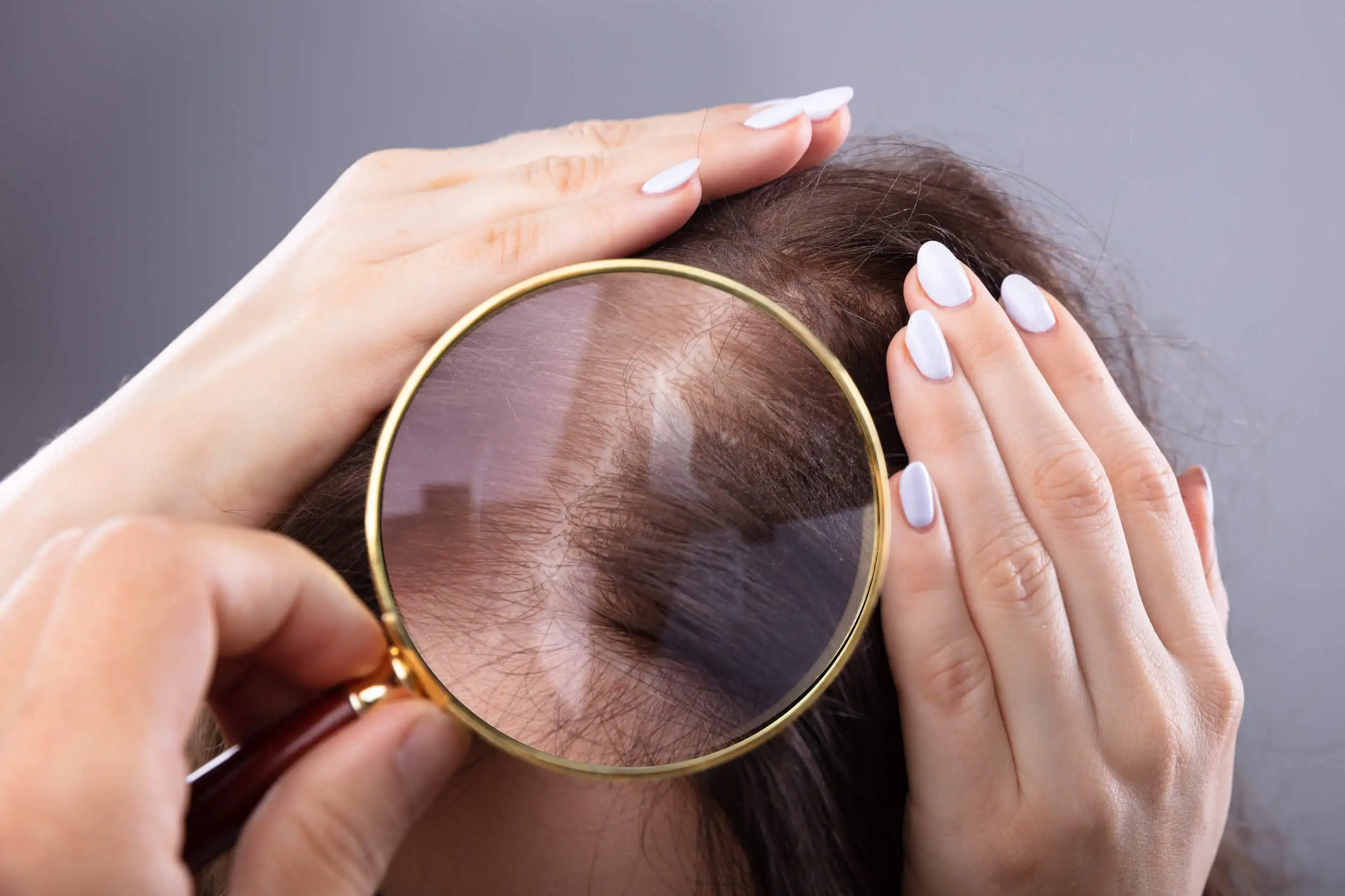 Los granos en la cabeza deben ser evaluados por un dermatólogo