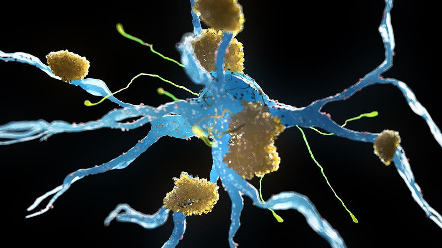 Neuronas con alzhéimer.