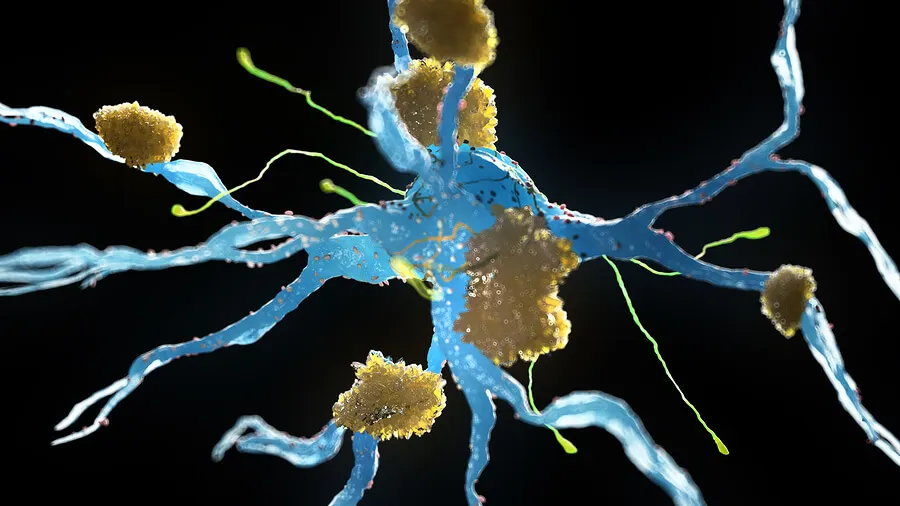 Neuronas con alzhéimer.