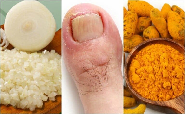 Cómo preparar 6 remedios caseros para aliviar los uñeros
