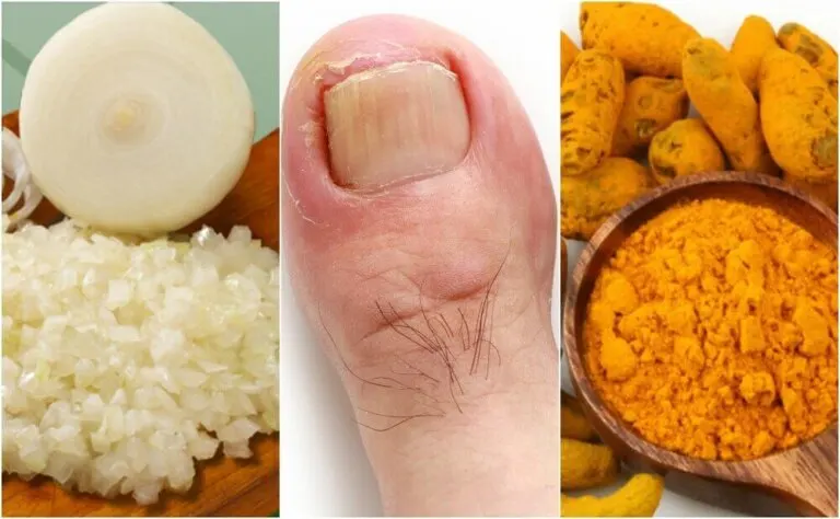 Cómo preparar 6 remedios caseros para aliviar los uñeros