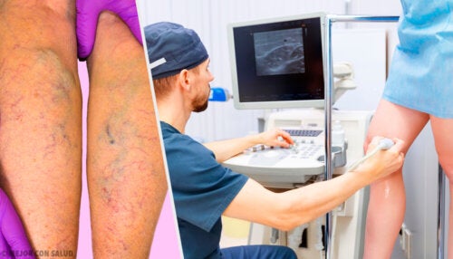 Tratamiento tópico y oral para prevenir y tratar las varices