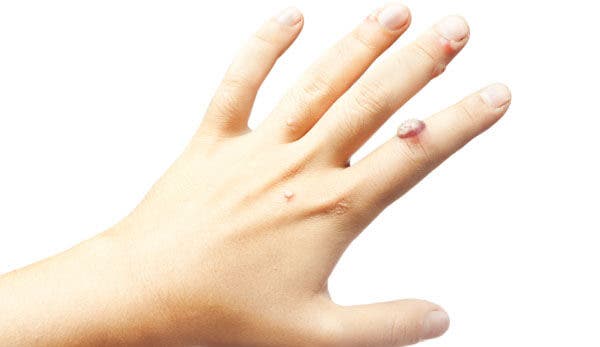 elimina-las-verrugas-con-esmalte