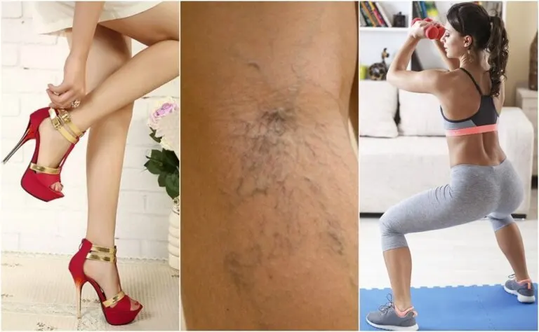 10 tips que te ayudan a evitar la aparición de venas varices