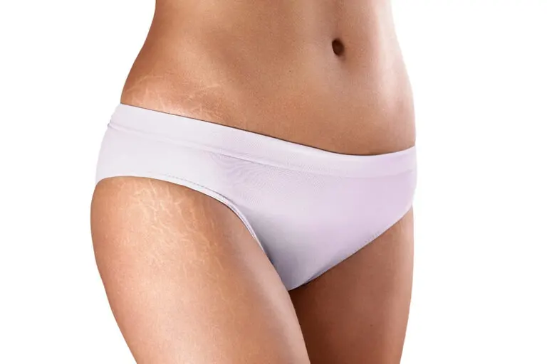 3 ingredientes naturales para reducir las estrías