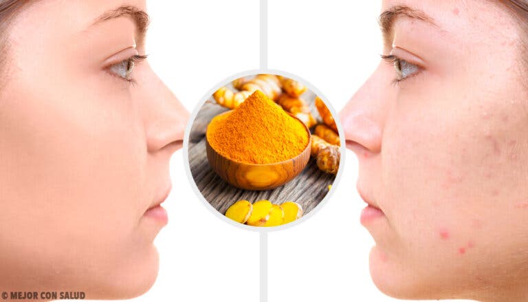 5 mascarillas con cúrcuma para eliminar las cicatrices de acné